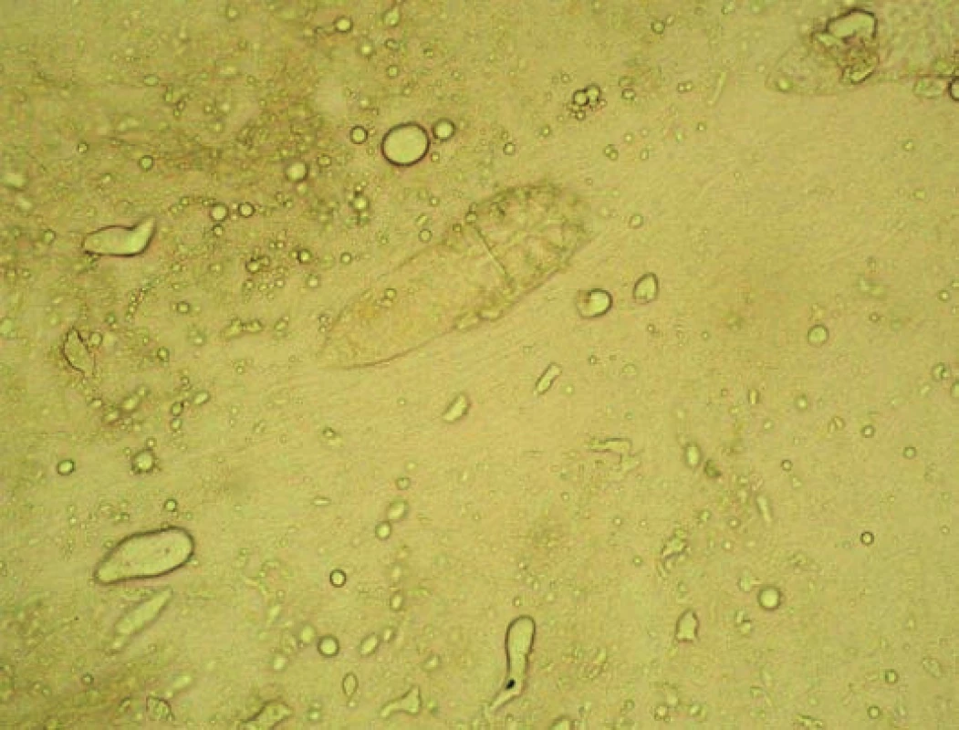 Opakovaný nález Demodex sp. a kandida