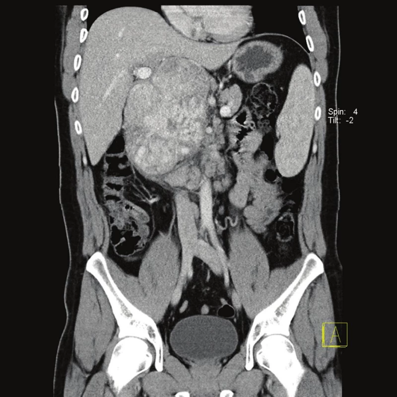 CT obraz tumoru retroperitonea – koronární řez
Fig. 1 : CT image of retroperitoneal tumor (coronal)