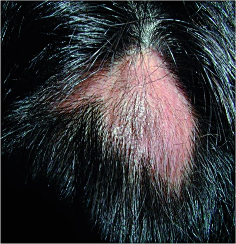 Alopecia areata před léčbou