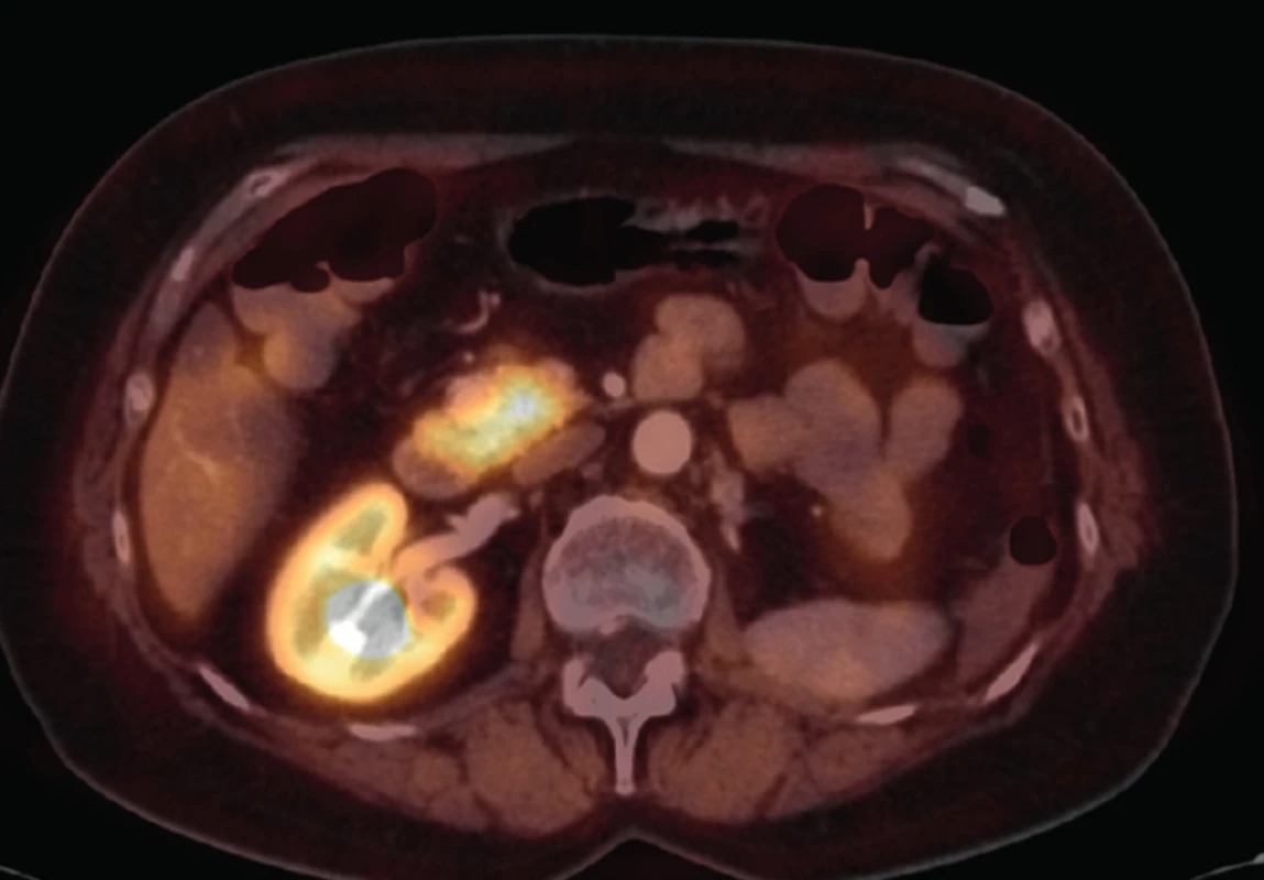 PET/CT
Fig. 4: PET/CT