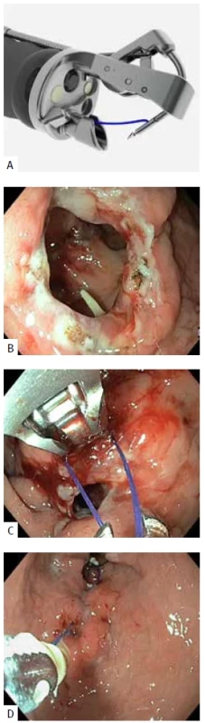 A) Apollo OverStitch Suturing System Sx™. B) Defekt stěny žaludku po sleeve resekci, okraje ošetřené APC (argon plasma koagulací). C) Průběh endoskopické sutury. D) Dotažení stehu.