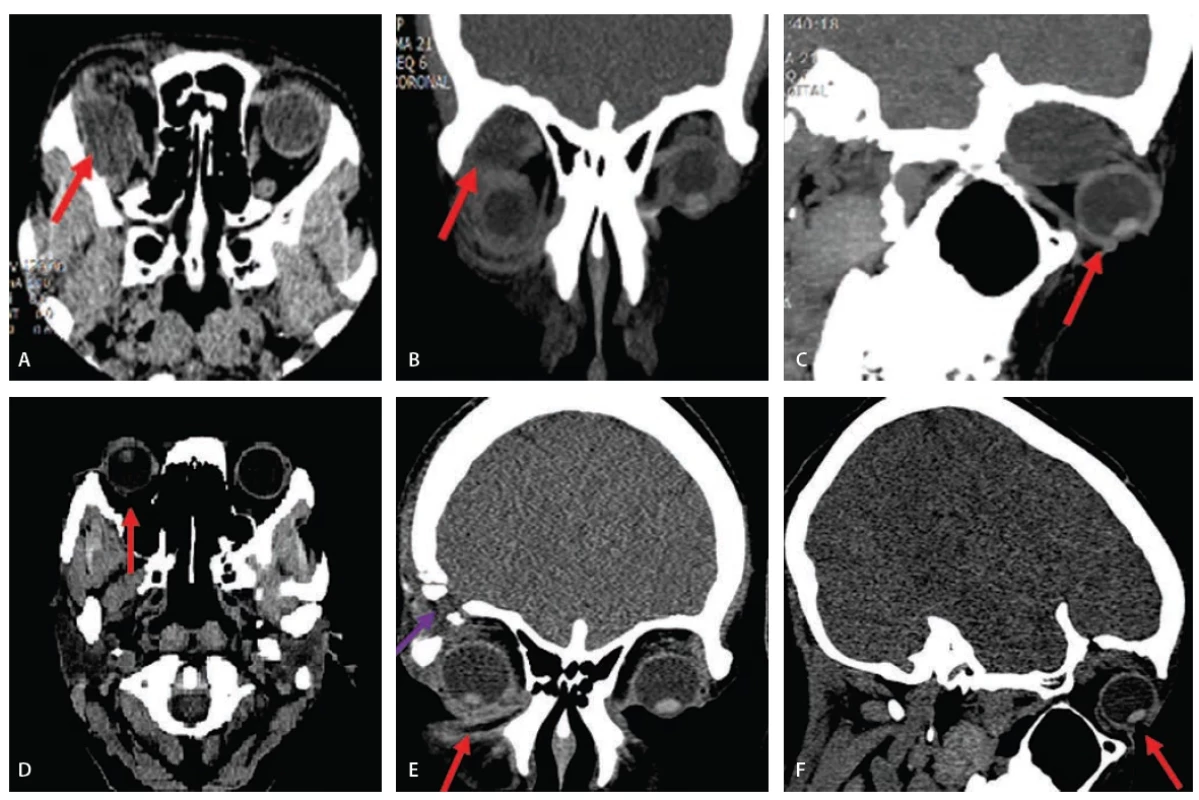 Pre-op optic nerve pushed by the cyst downward and the eyeball inferolaterally in axial (A) and coronal (B) CT scan. (C) Pre-op proptosis in sagittal CT scan. (D) Post-op proptosis resolved in axial CT scan. (E) Post-op proptosis resolved in coronal CT scan, frontotemporoorbitozygomatic craniotomy. (F) Post-op proptosis resolved in sagittal CT scan.