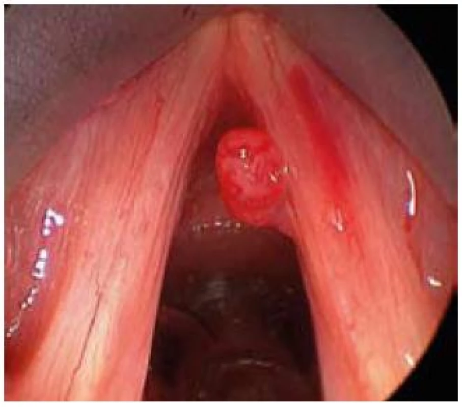 Hemangiom pravé hlasivky.
Fig. 6. Right vocal cord haemangioma.