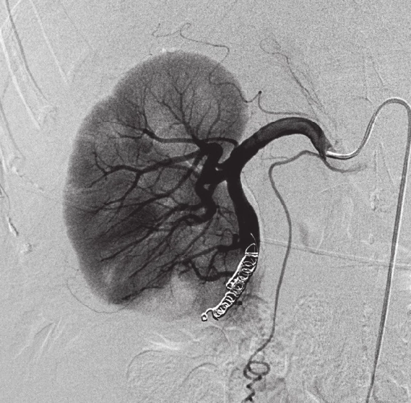 Následná embolizace krčku pseudoaneuryzmatu a přívodné arterie embolizačními spirálami Tornado <sup>®</sup>
Fig. 5. Subsequent embolization of the pseudoaneurysm neck and the aff erent artery with Tornado<sup>®</sup> embolization microcoils