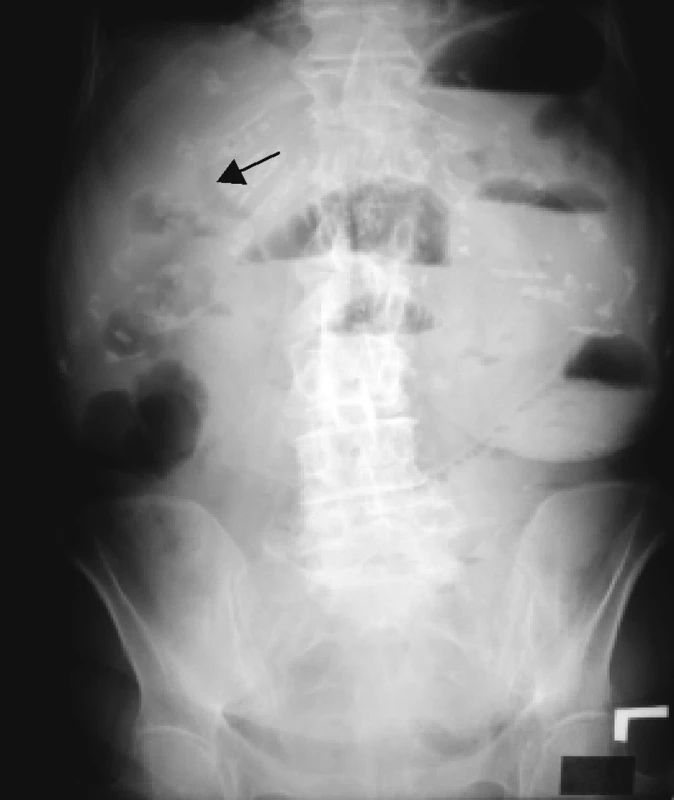 RTG brucha – vysoký ileus a aerobília – označená šípkou
Pic. 6. X ray of abdomen – high ileus and aerobilia – marked with arrow