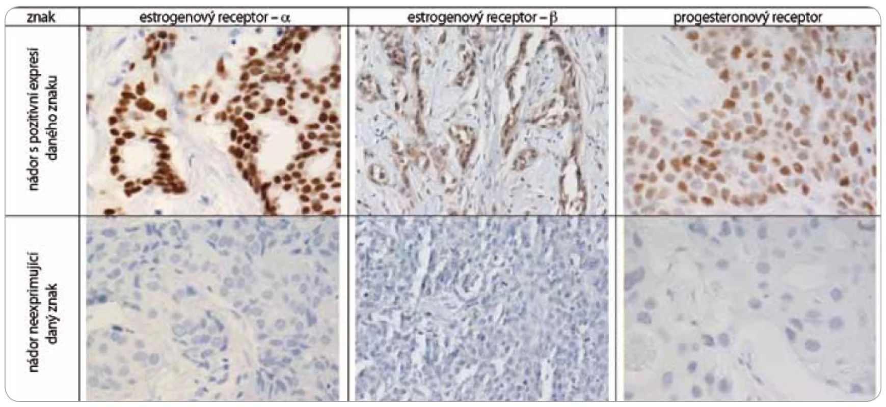 Imunohistochemické vyšetření sledovaných znaků v nádorové tkáni karcinomů prsu.