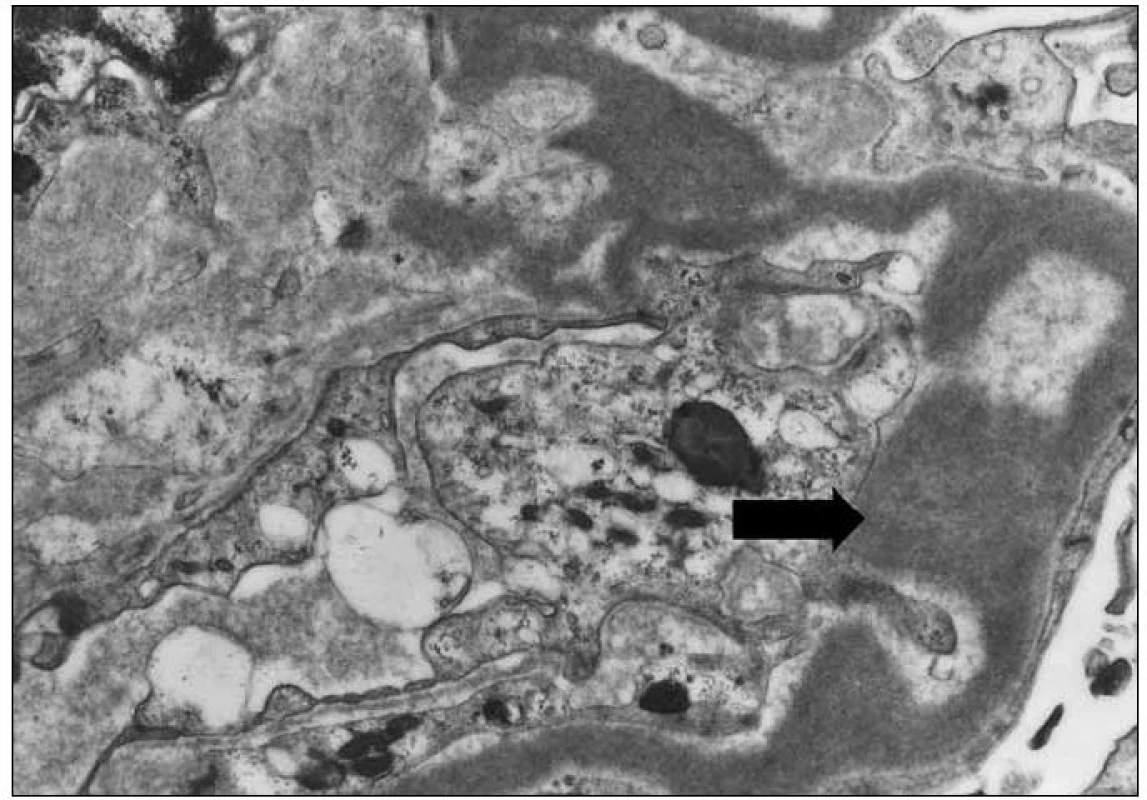 Elektronmikroskopický obraz granulárních elektrondenzních depozit v glomerulární bazální membráně (šipka). Původní zvětšení 4 000krát.
