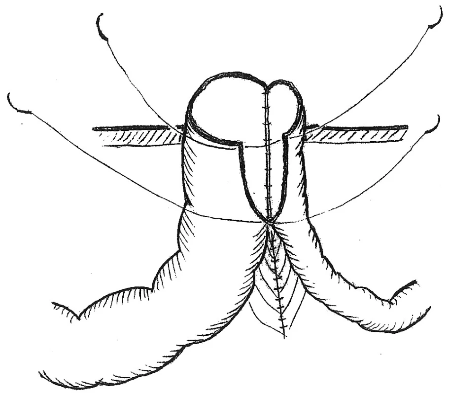 Modifikácia Grossovej metodiky, pri ktorej je stomovaná side to side anastomóza širokého orálneho a úzkeho aborálneho črevného segmentu
Fig. 3. A modification of the Gross method, where the side to side anastomosis of the wide oral and narrow aboral intestinal segments is undone