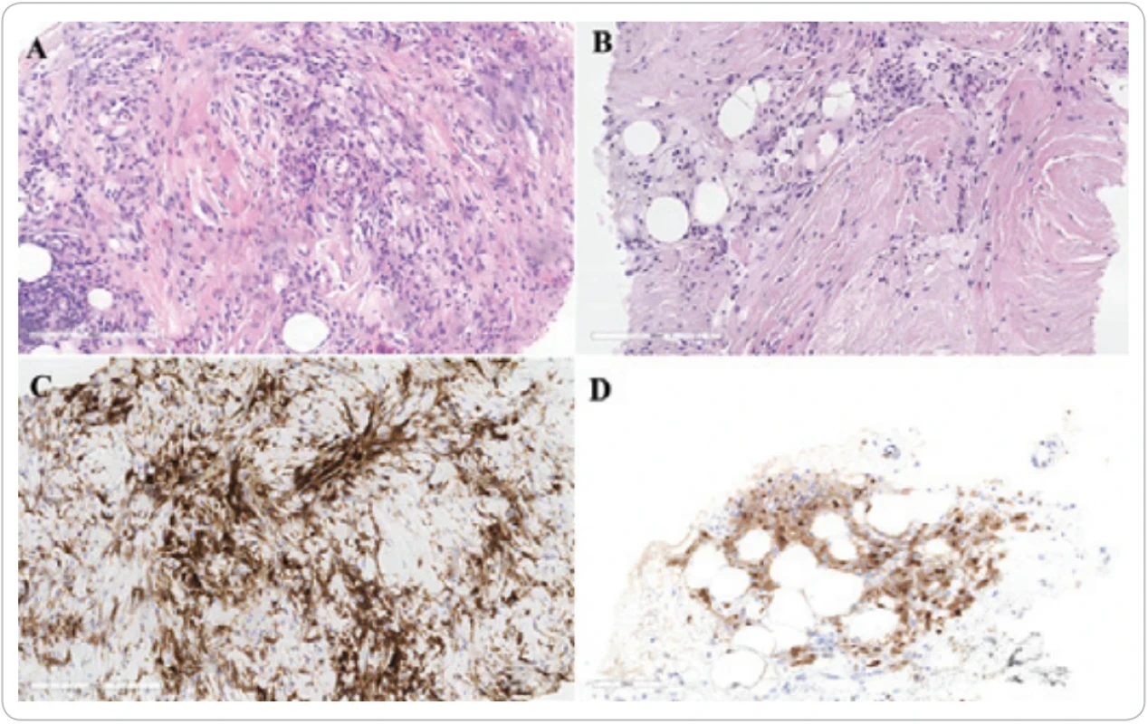 Histologický nález z biopsie retroperitonea (A) a retroorbitálního prostoru (B), kde jsou pěnité histiocyty ve fi bróze. Pozitivita histiocytů v CD163 (C) a aberantní jaderná a cytoplazmatická exprese v cyklinD1 (D).
