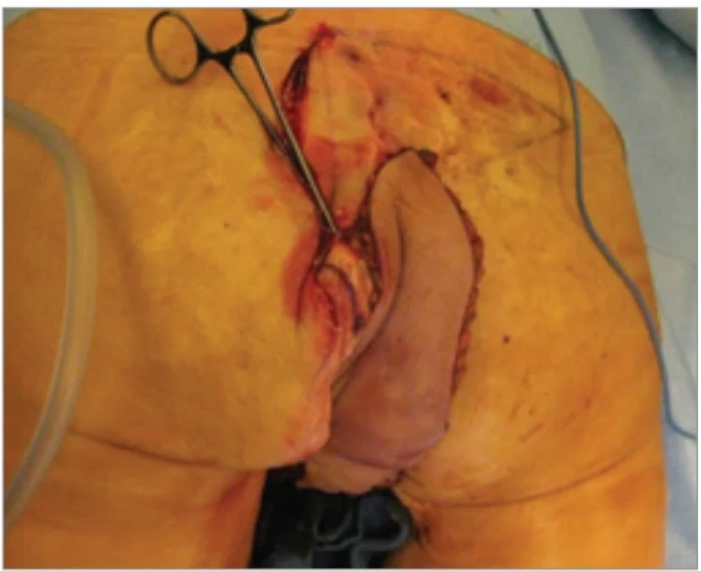Flap’s position after tunneling to the perineal region; note that the patient was positioned in a prone position.