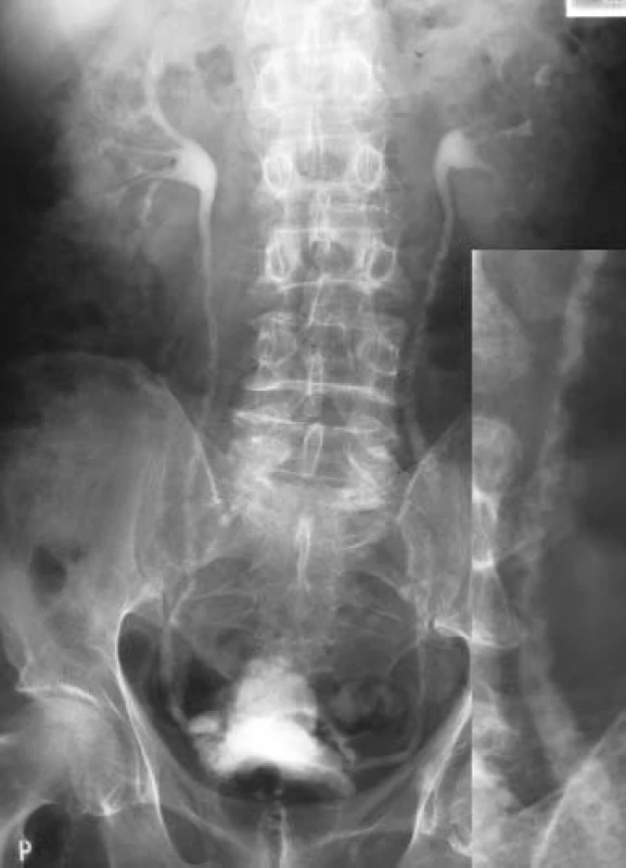 Ureteritis cystica, deformace m.m, divertikly (IVU).
