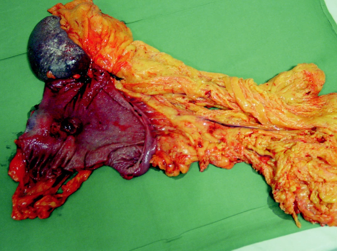 Resekát – en block preparát žaludek s tumorem, omentem a slezinou
Fig. 3. The resecate – en block preparation of the stomach with the tumor, the omentum and the spleen