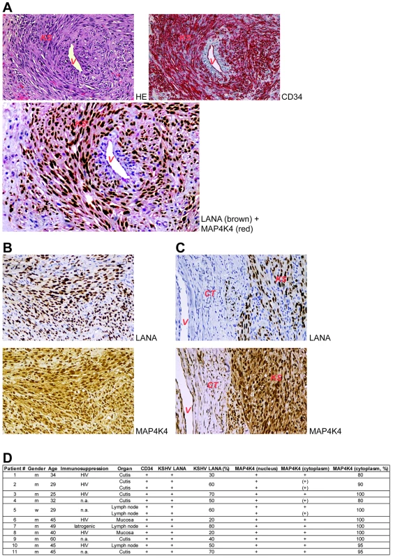 MAP4K4 is expressed in endothelial spindle cells in KS tumours.