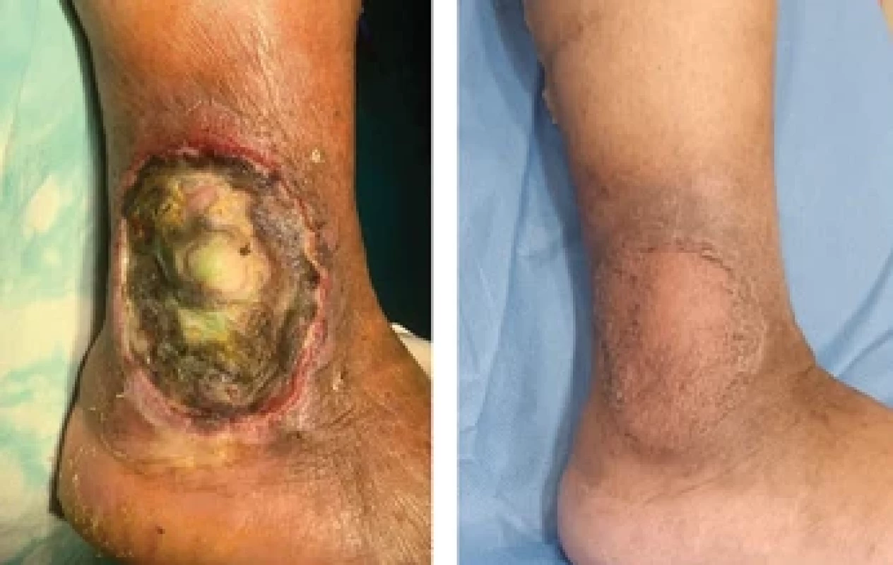 A 61year-old female with DVT, varicosities and APLA vasculitis treated with matrix and SSG had scar which had near-to-normal skin features.
