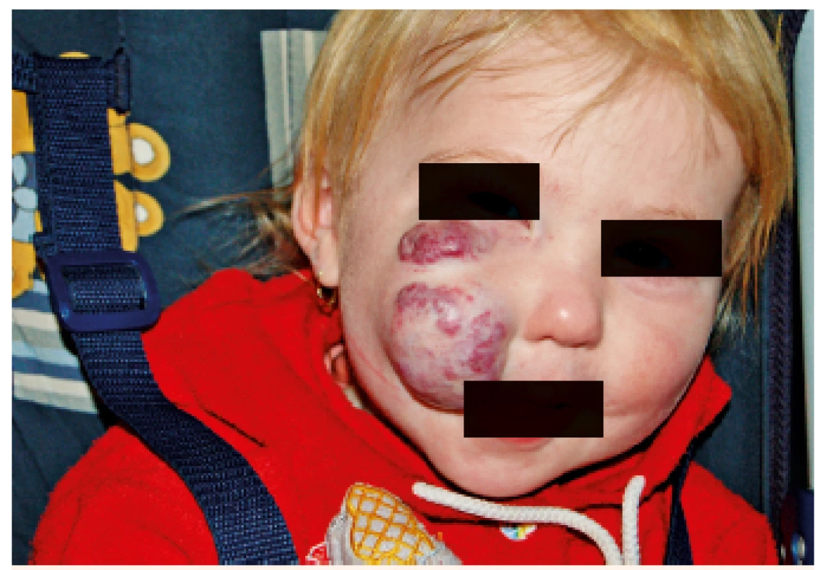 Reziduum neléčeného hemangiomu u 2letého dítěte.
Fig. 7. Residue of untreated hemangioma in two years old child.