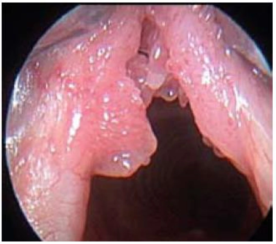 Papilomatóza hrtanu.
Fig. 5. Laryngeal papillomatosis.