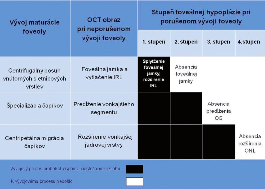 Stupne FH podľa poruchy vývoja maturácie foveoly a korelácia OCT obrazu.