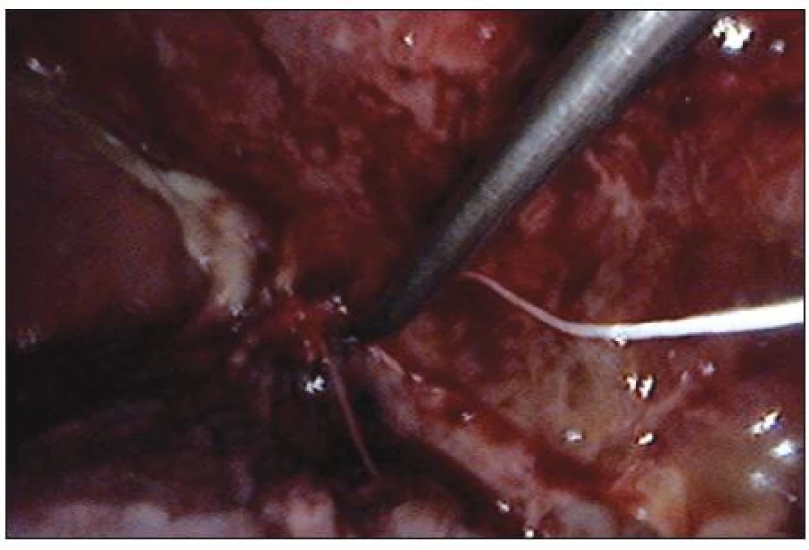 VATS Peroperační snímek při VATS dekortikaci u časné fáze 3. stadia empyému hrudníku
Fig. 4. Intraoperative view during VATS decortication in early stage III thoracic empyema
