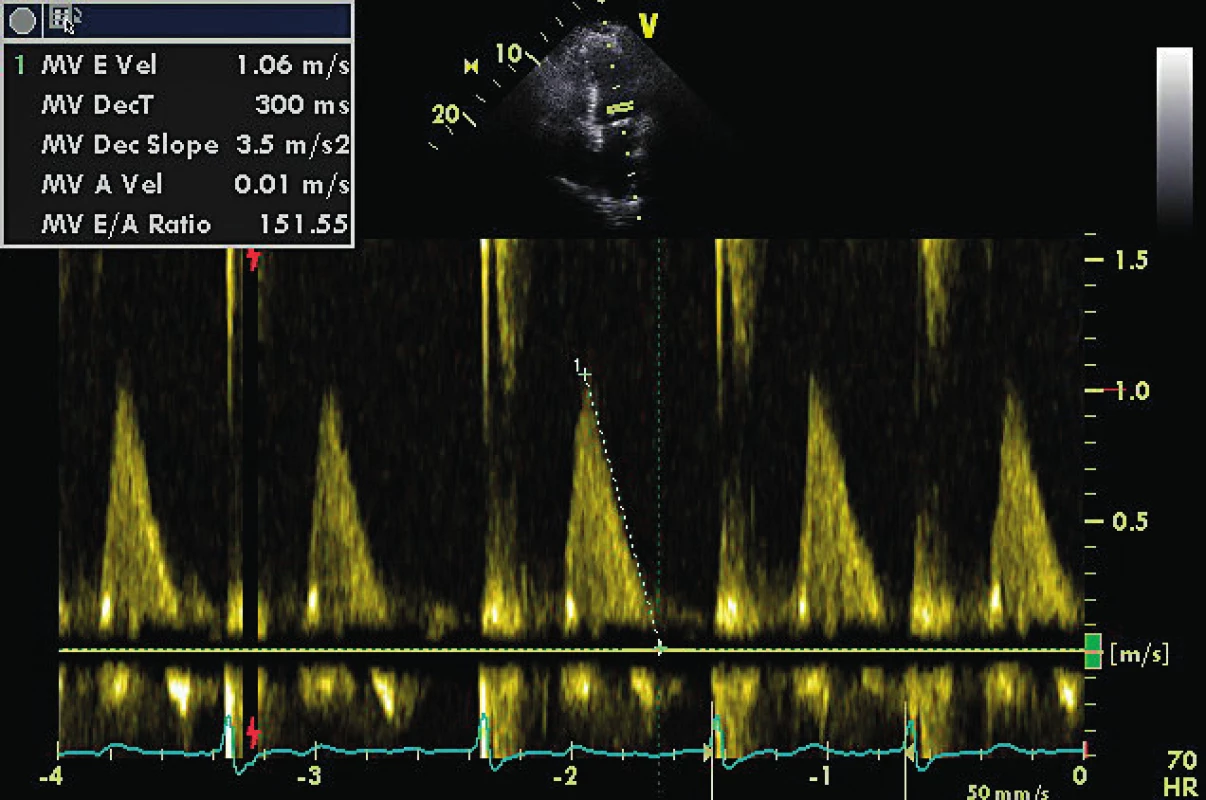 Transmitrální doppler u pacienta s AF a periferním pulzním deficitem do 10/min, komorovou odpovědí 70/min