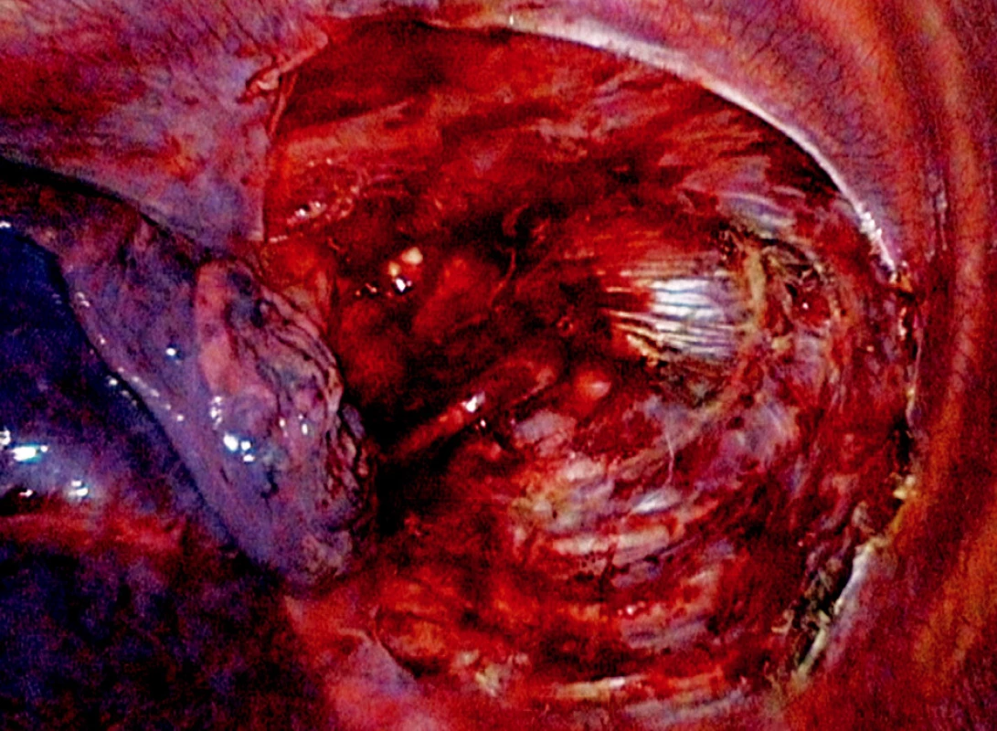 Apikální parciální pleurektomie vlevo (operační foto)
Fig. 4. Partial apical pleurectomy on the left (intraoperative photo) 