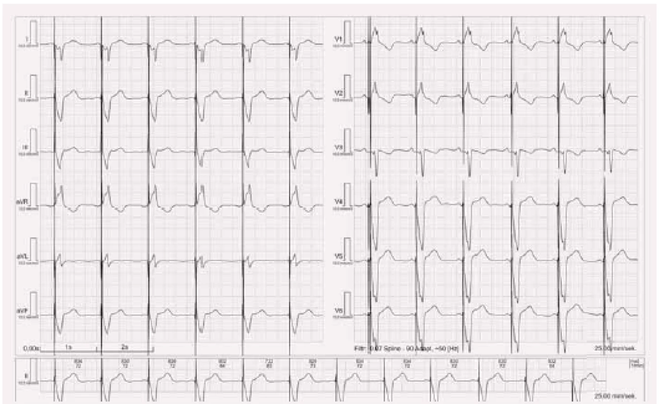 EKG stimulace levé komory.
