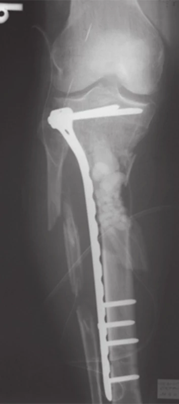 Stabilizácia pravej tíbie uhlovo stabilnou dlahou, vyplnenie kostného defektu antibiotickým spacerom.
Fig. 7: Fixation of the right tibia with internal fixator (locked plate) – MIPPO technique, filling of bone defect with antibiotic spacer