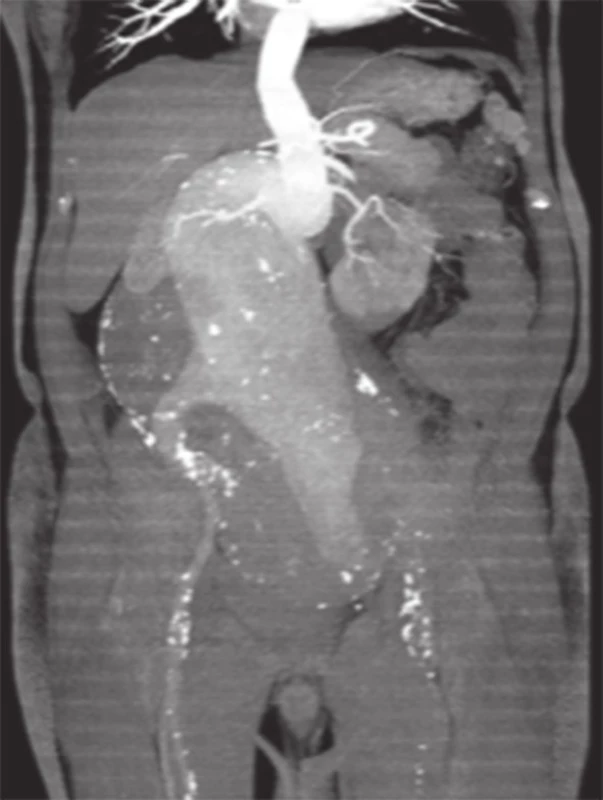 CT AG gigantického AAA v sagitální rovině - patrná angulace krčku
Fig. 1. CT AG of giant AAA in the sagittal plane – with visible angulation of the neck of AAA