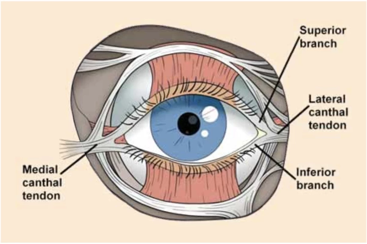 Lateral canthotomy and cantholysis. // Laterální kantotomie a kantolýza.