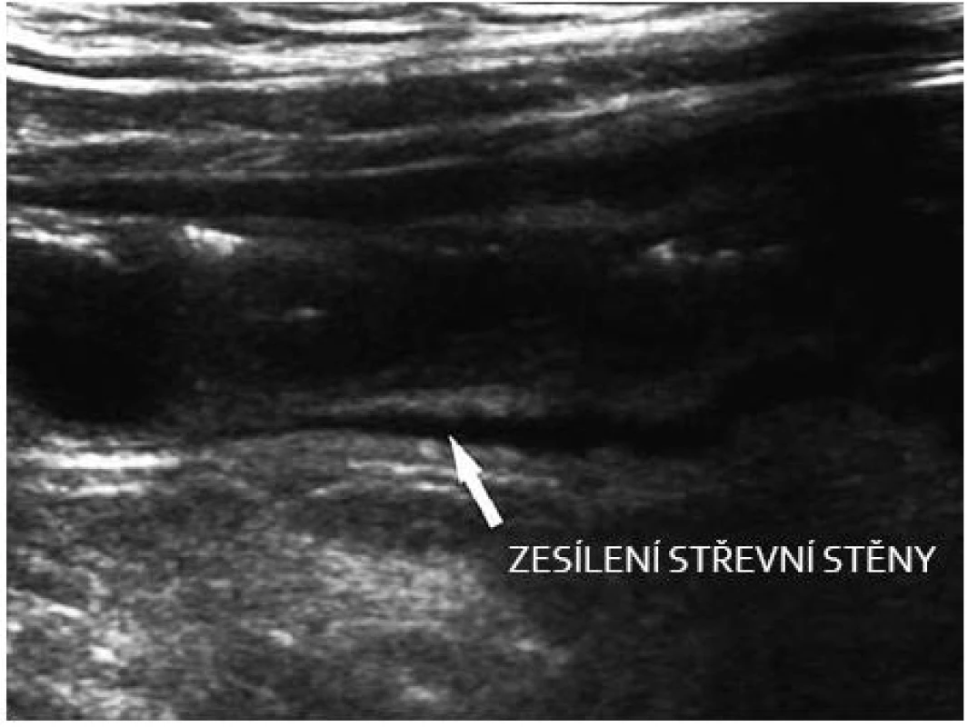 Crohn – aktivní zánět v oblasti ilea.
Fig. 2. M. Crohn – active inflammation of the ileum.