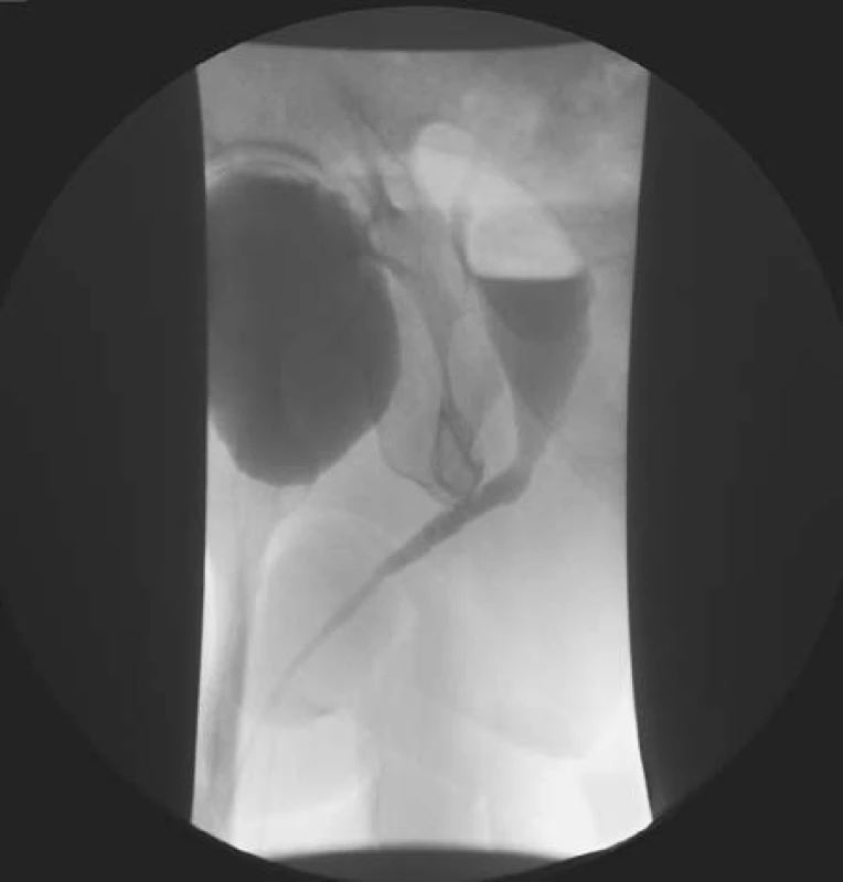 Uretrocystografie – při mikci se kontrastní látkou plní ohraničená dutina odpovídající ingvinoskrotální herniaci močového měchýře
Fig. 4. Urethrocystography – massive inguino-scrotal herniation of bladder filled with contrast agent during voiding phase