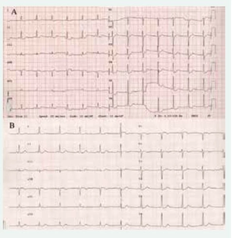 EKG u pacientky s feochromocytomem před operací (A) ukazující na difuzní změny ST úseku a 5. pooperační den (B), kde tyto změny již nejsou patrné