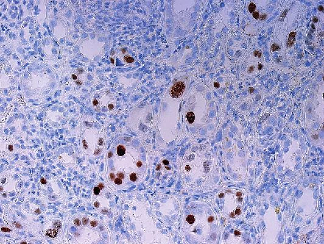 Polyomavirová nefropatie, imunohistochemický průkaz viru verifikuje četná infikovaná jádra, část z nich je zvětšených a část je zastižených okrajově a má normální velikost (objektiv 20x).