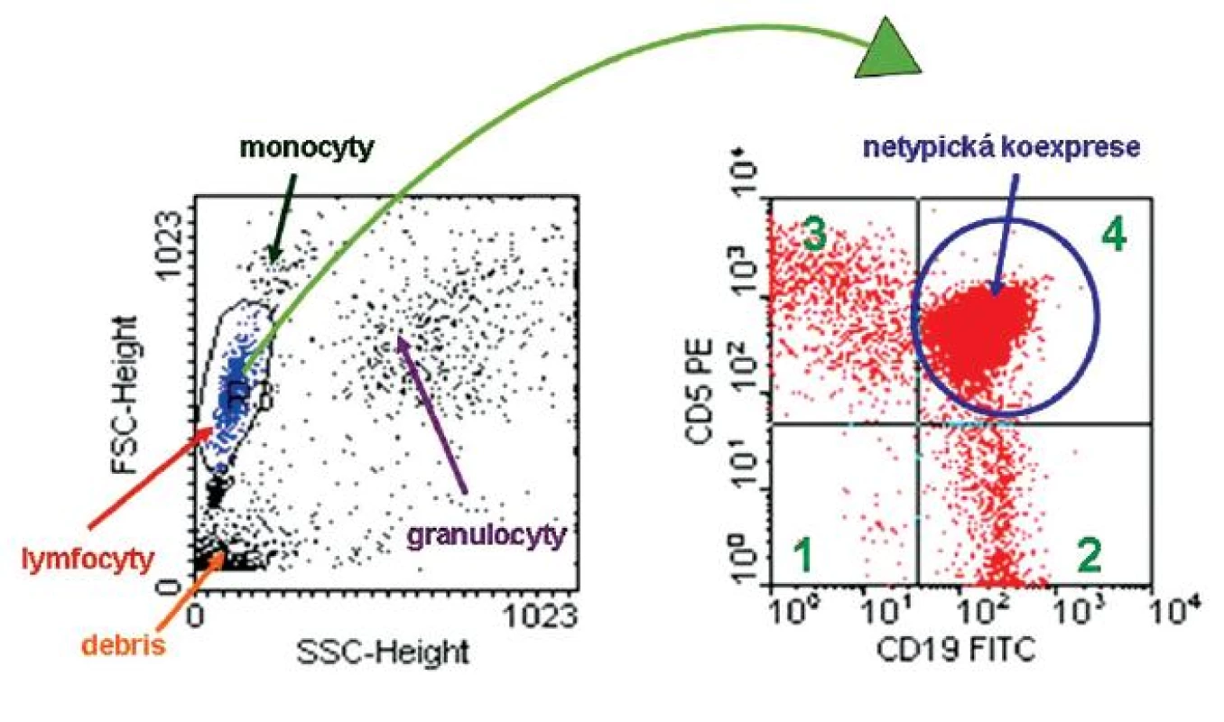 Analýza cytometrických dat, vzorek periferní krve se suspekcí na lymfoproliferativní onemocnění. Dot-plot SSC/FSC znázorňuje rozložení buněk podle granularity (SSC) a velikosti (FSC) – dle těchto parametrů rozlišujeme buněčné subpopulace lymfocytů, monocytů, granulocytů a debris. V rámci počítačového zpracování naměřených dat je možné „zagatovat“ určitou subpopulaci, u které dále vyhodnotíme expresi či absenci námi měřených parametrů.
„Gatujeme“ populaci lymfocytů a ve druhém dot-plotu CD19 FITC / CD5 PE již zobrazujeme pouze vybrané buňky. V tomto dot-plotu můžeme rozpoznat čtyři buněčné subpopulace: v kvadrantu 1 – buňky neexprimující ani molekulu CD19 ani molekulu CD5, buňky se vyznačují pouze svou autofluorescení; v kvadrantu 2 – buňky s expresí molekuly CD19, po vazbě fluorescenční protilátky anti-CD19 FITC se zvýšila intenzita jejich fluorescence (B-lymfocyty); v kvadrantu 3 – buňky s expresí molekuly CD5, po vazbě fluorescenční protilátky anti-CD5 PE se rovněž zvýšila intenzita jejich fluorescence (T-lymfocyty); v kvadrantu 4 – buňky s koexpresí molekuly CD19 a CD5 (aberantní koexprese u nádorových buněk) Koexprese molekuly CD19 a CD5 je typická pro chronickou lymfocytickou leukémii a pro lymfom z buněk pláště, přesnější určení je potom možné díky podrobnější imunofenotypizaci.