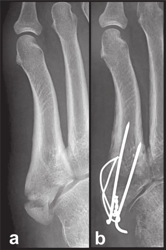 Osteosyntéza tahovou cerkláží
Fig. 6: Internal fixation by tension band wiring