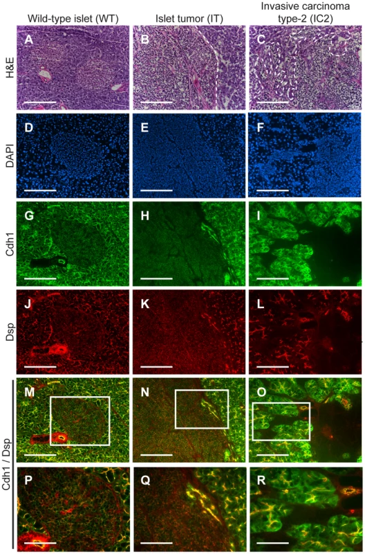 <i>Desmoplakin</i> and <i>cadherin 1</i> expression in wild-type islets and <i>RT2</i> PNETs.
