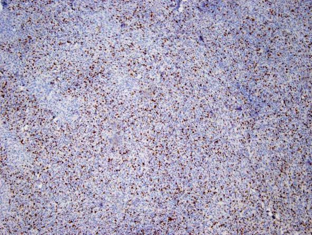 Recidiva tumoru − imunohistochemické vyšetření Ki-67 − vysoký počet pozitivních jader svědčí pro vysokou proliferační aktivitu a agresivitu tumoru
Fig. 9: Tumor recurrence - Ki-67 immunohistochemistry – the high number of positive cores suggests a high proliferative activity and tumor aggressiveness