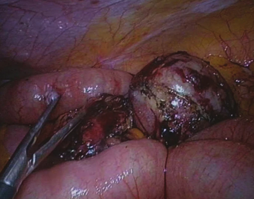 Nádor mezenteria před extrakcí minilaparotomií
Fig. 6: Mesenteric tumour before extraction by minilaparotomy