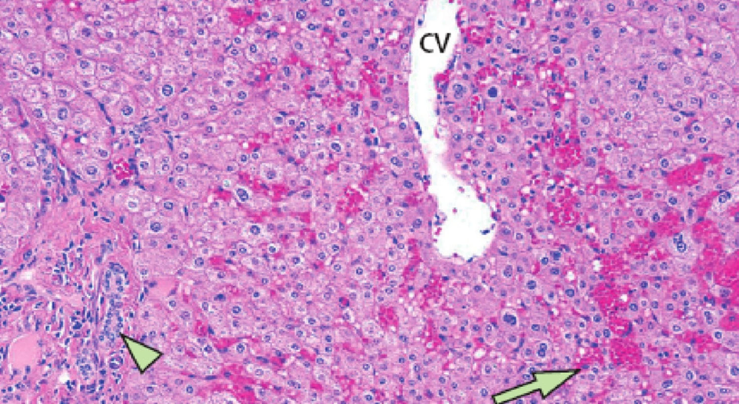 Projev hepatotoxicity neoadjuvantní chemoterapie – sinusoidální poškození