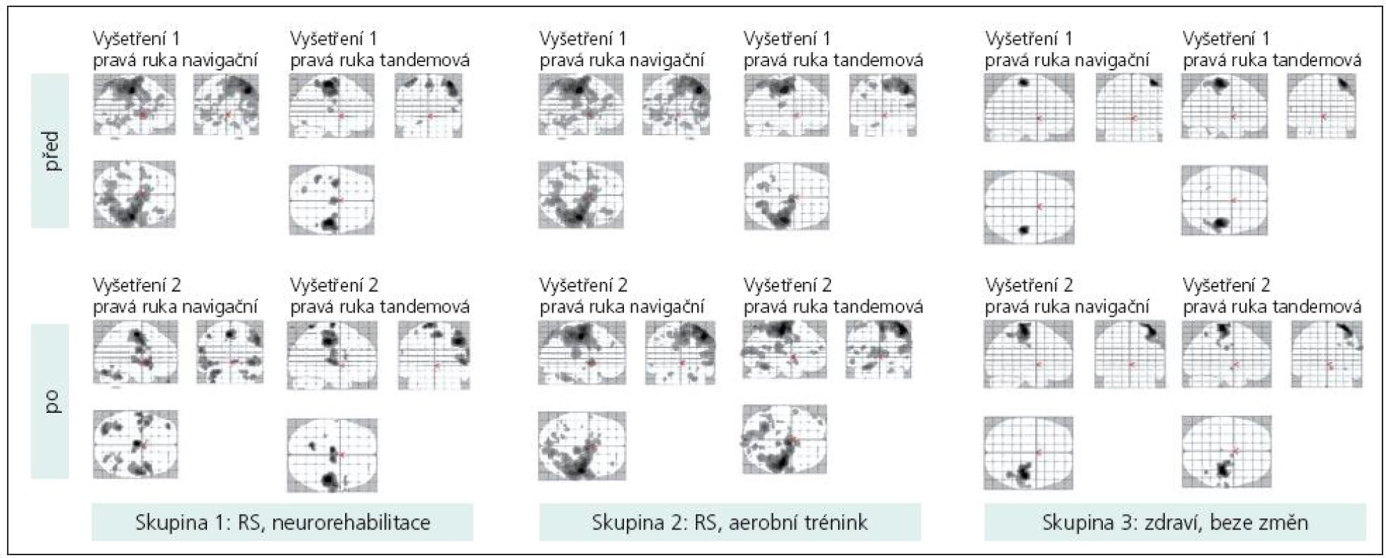 Magneticko rezonanční obraz u vybraných probandů z každé skupiny na začátku a na konci programu.
U pacienta, který absolvoval neurorehabilitaci, můžeme sledovat změnu vzorce mozkové aktivace.