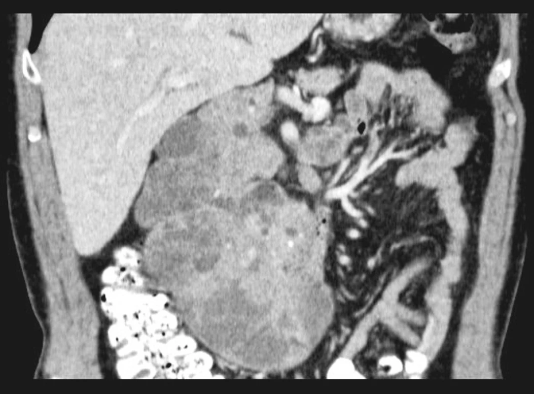 Předoperační CT zobrazení
Fig. 1. Preoperative CT examination
