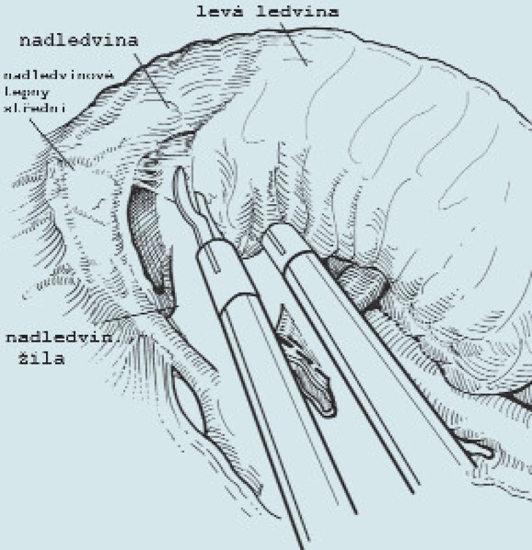 Oddělení ledviny od nadledviny a následné uvolnění celé ledviny i s tukovým pouzdrem.