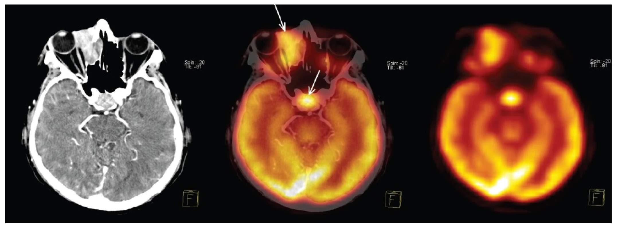 <sup>18</sup>F-FDG PET/CT v období stanovení diagnózy prokazuje hyperakumulaci <sup>18</sup>F-FDG v tkáni difuzního B-velkobuněčného lymfomu v pravé orbitě i v adenomu hypofýzy. Tomografické řezy proložené rovinou procházející pravou orbitou i adenomem hypofýzy. Zleva CT, fúze PET/CT, PET. Šipky ukazují hyperakumulaci <sup>18</sup>F-FDG v obou nádorech.