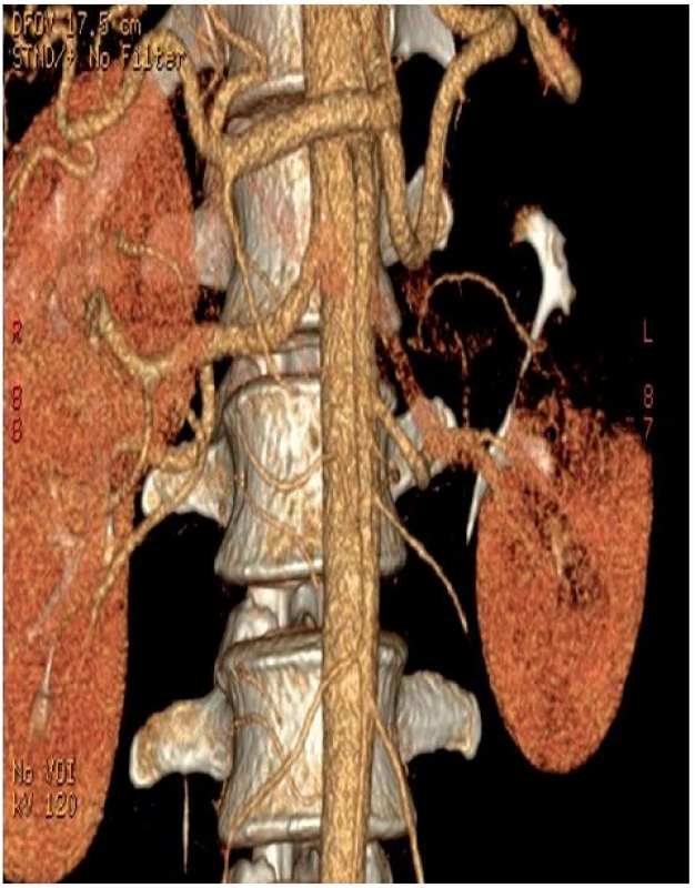3D rekonstrukce CT angiografie – patrná je aberantní arterie pro dolní pol levé ledviny, ischémie horní poloviny ledviny s kontrastem v dutém systému 
Fig. 1. CT angiography, 3D reconstruction – see the aberrant artery supplying the lower pole of the left kidney, ischemic cranial kidney moiety with contrast medium in pelvis