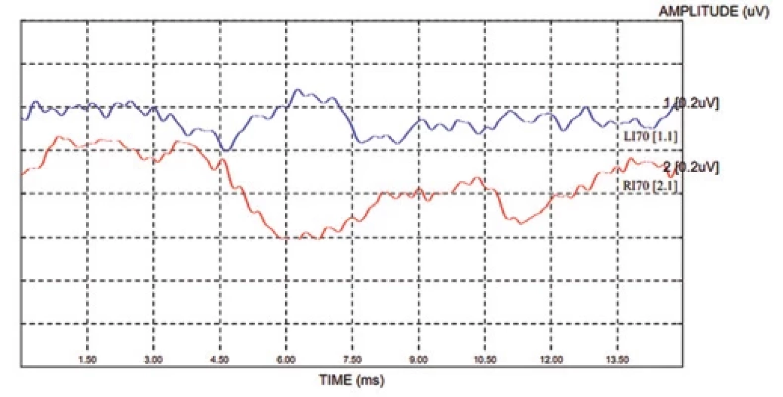 BAEP, click 70 dB, alternační fáze stimulu. Evokované kmenové odpovědi nevykazují synchronicitu, nelze posoudit latence.BAEP, alternating click, 70 dB. There is no synchronicity in evoked brainstem responses. It is impossible to detect latencies.