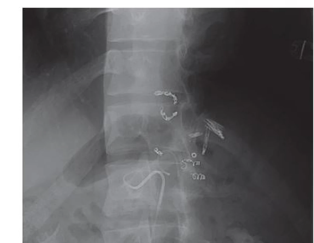 Vaskulární intervence – selektivní arteriografie s embolizací arteria gastrica sinistra a arteria lienalis.
Zdroj: Jiri Novotny M.D., Ph.D., Pracoviště radiodiagnostiky
a intervenční radiologie, IKEM.<br>
Fig. 3. Vascular intervention – selective arteriography with
embolization of arteria gastrica sinistra and arteria lienalis.
Source: Jiri Novotny M.D., Ph.D., Radiology and Intervention
radiology, IKEM.