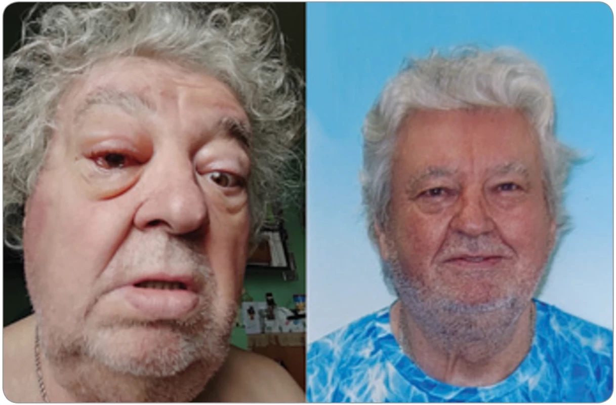  Obličej s protruzí oka a foto po léčbě. Vlevo foto pacienta z června 2025 – otoky  víček, spojivek a protruze levého oka způsobené tlakem zvětšené slzné žlázy. Vpravo foto grafi e pacienta po léčbě, žádná protruze oka již není patrná. Pacient po