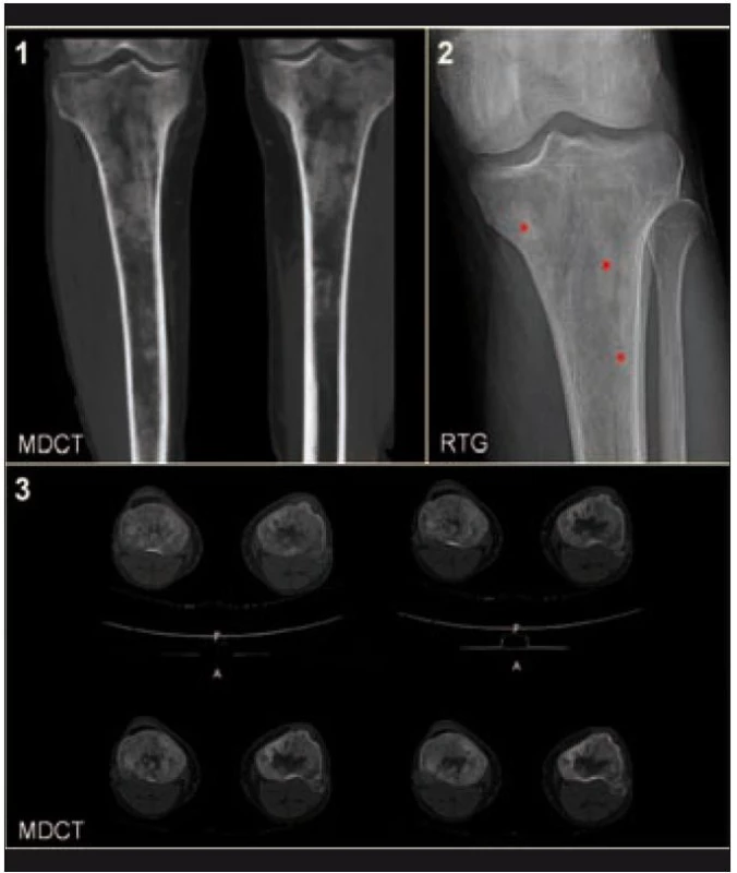 Zobrazení tibie metodou konvenční radiografie (RTG) a metodou multidetektorové výpočetní tomografie (MDCT).

(1) MDCT, MIP rekonstrukce v koronární rovině: zřetelná osteoporotická struktura s osteosklerotickými ložisky.

(2) RTG: tečkami jsou označena osteosklerotická ložiska.

(3) MDCT, axiální rovina: patrné je zesílení hydroxyapatitových struktur kortikalis a spongiózy.
