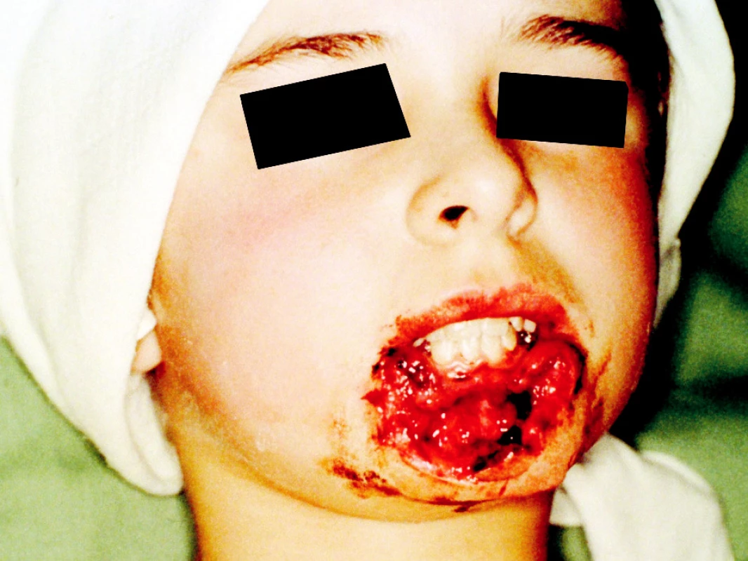 Ztrátové poranění dolního rtu (90 %) s odloženou rekonstrukcí
Pic. 1. A defect injury of the lower lip (90%) with delayed reconstruction