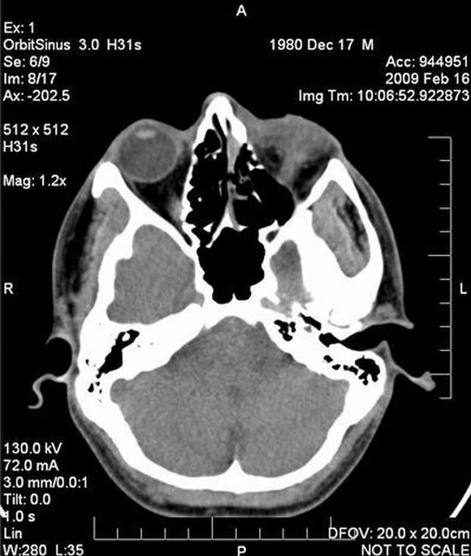 CT lebky: Pneumoorbita vlevo s intraorbitální hemorhagií, chybějící bulbus a zrakový nerv vlevo