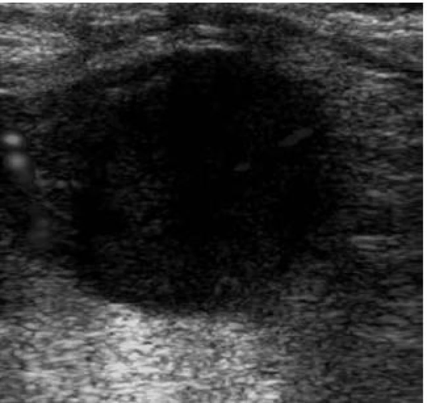 Nádorové postižení tenkého střeva – metastáza adenokarcinomu caeka na kličce ilea.
Fig. 9. Small intestine tumour – metastatic adenocarcinoma of the caecum on the ileum loop.